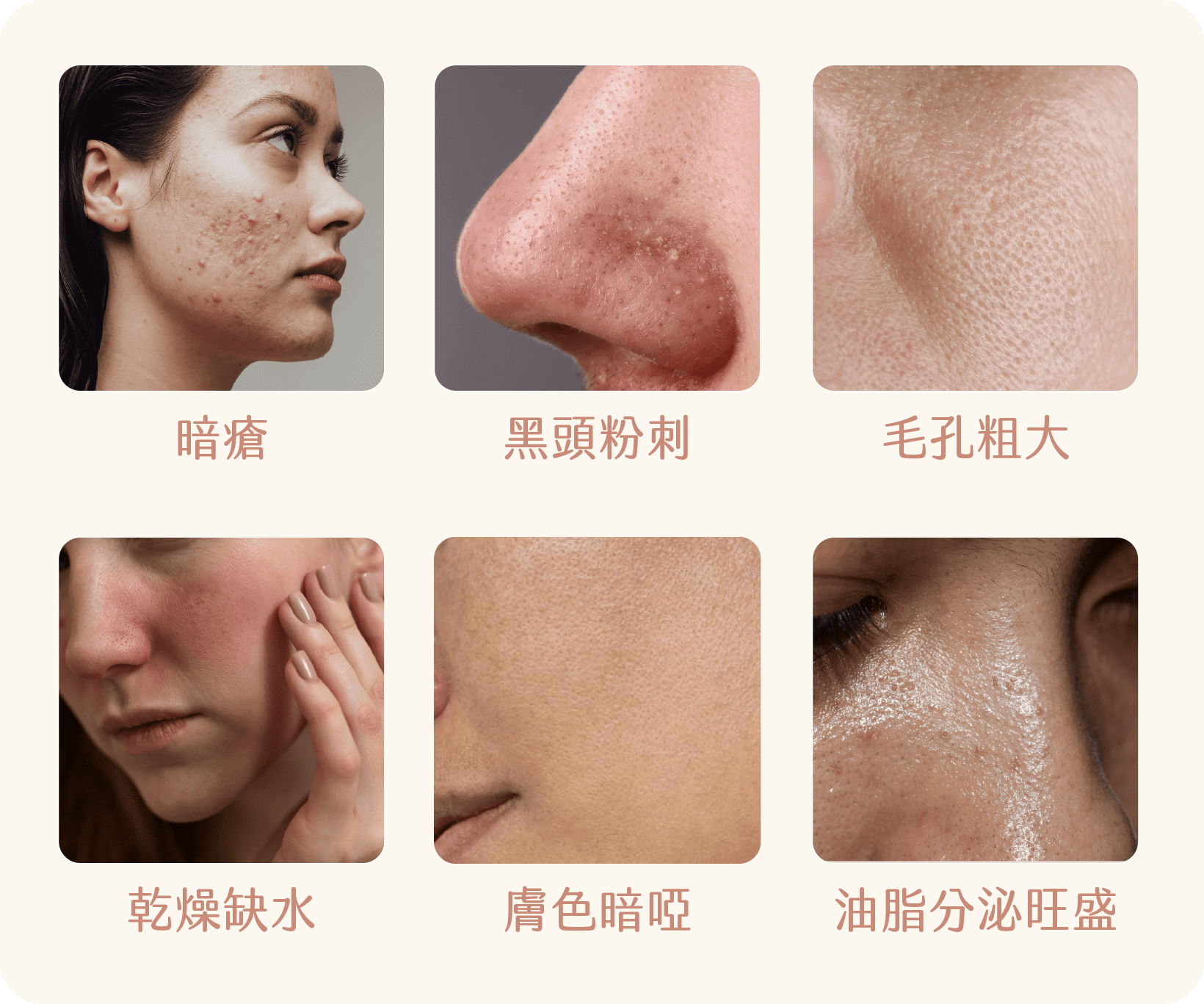 抗痘換膚治療方案適合人群