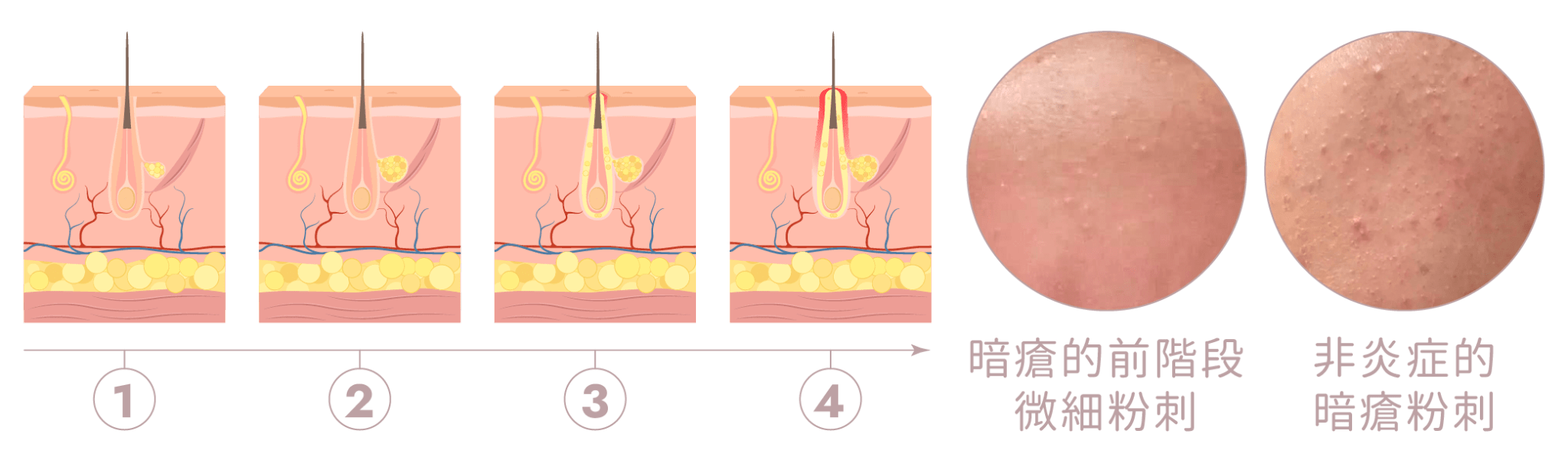 暗瘡形成