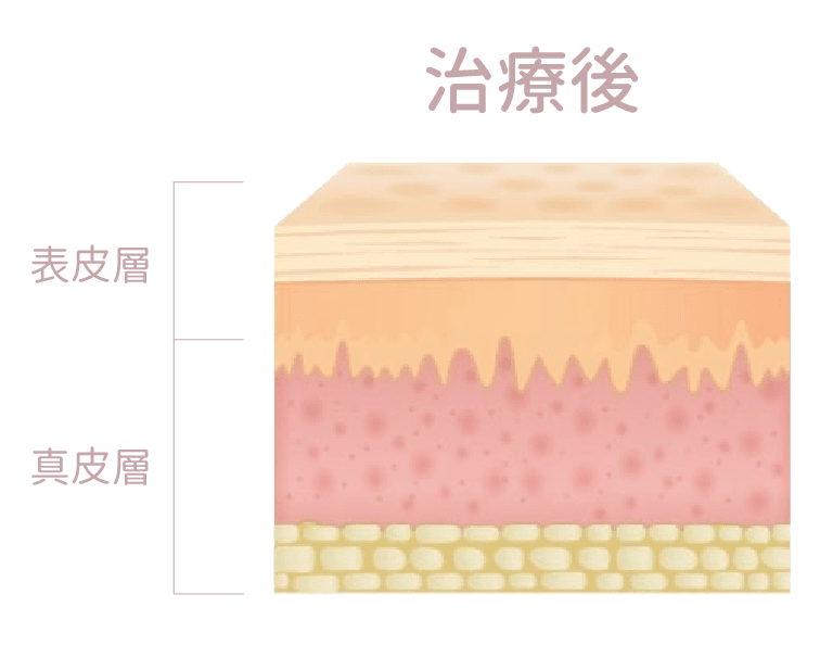 膠原槍 效果