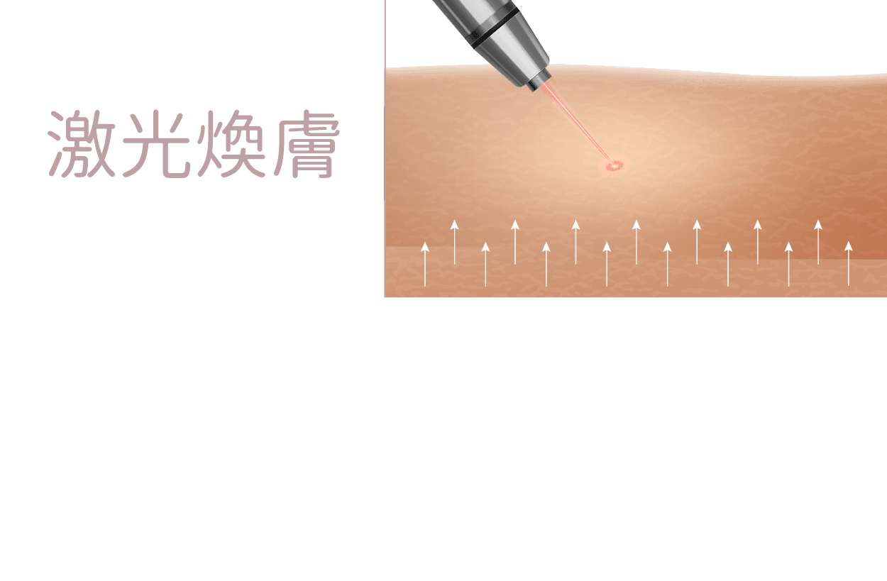 激光煥膚