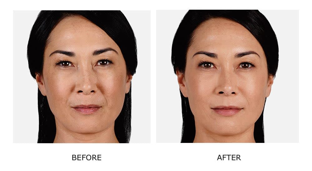 JUVÉDERM® 喬雅登透明質酸