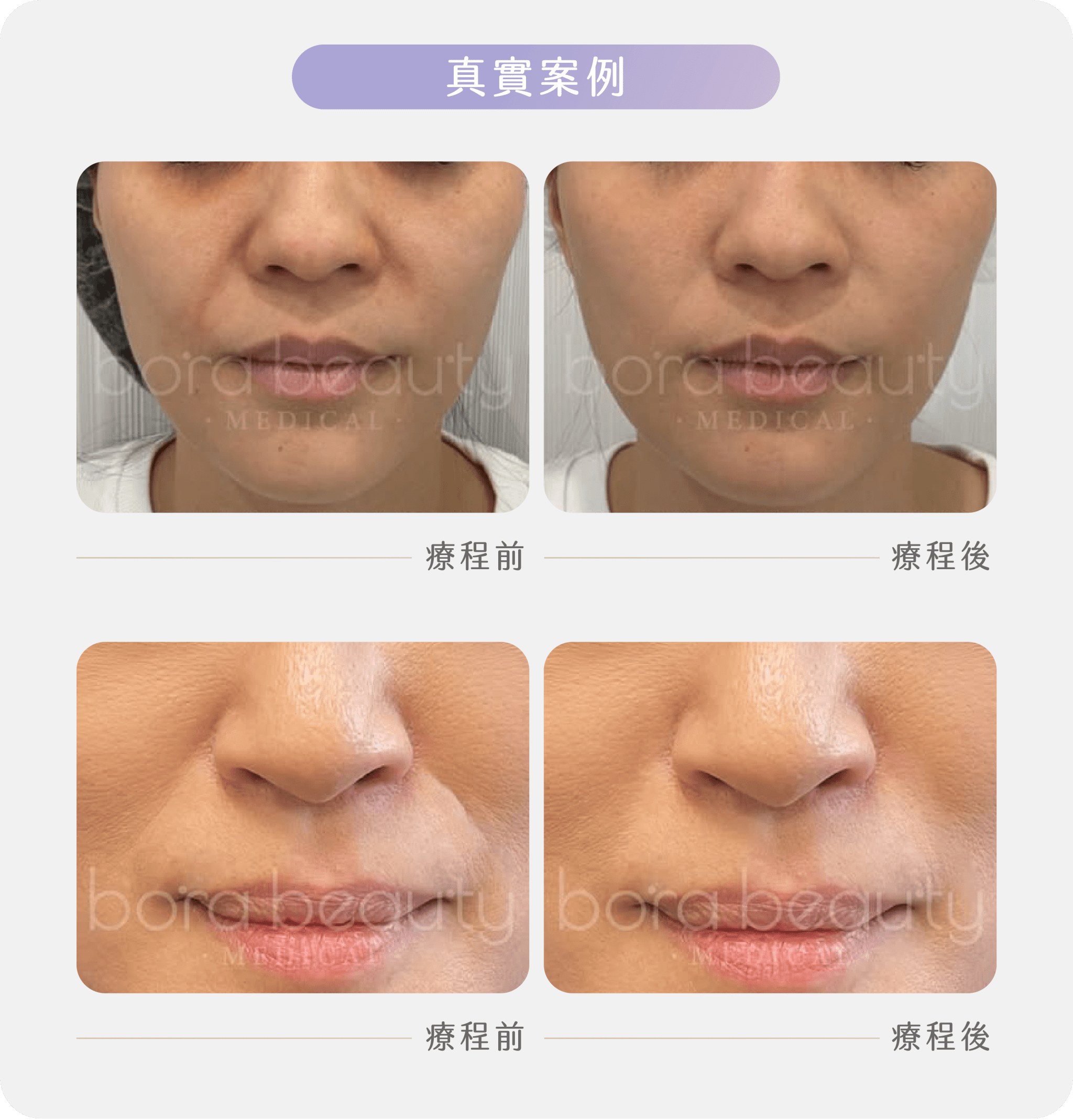 療程效果