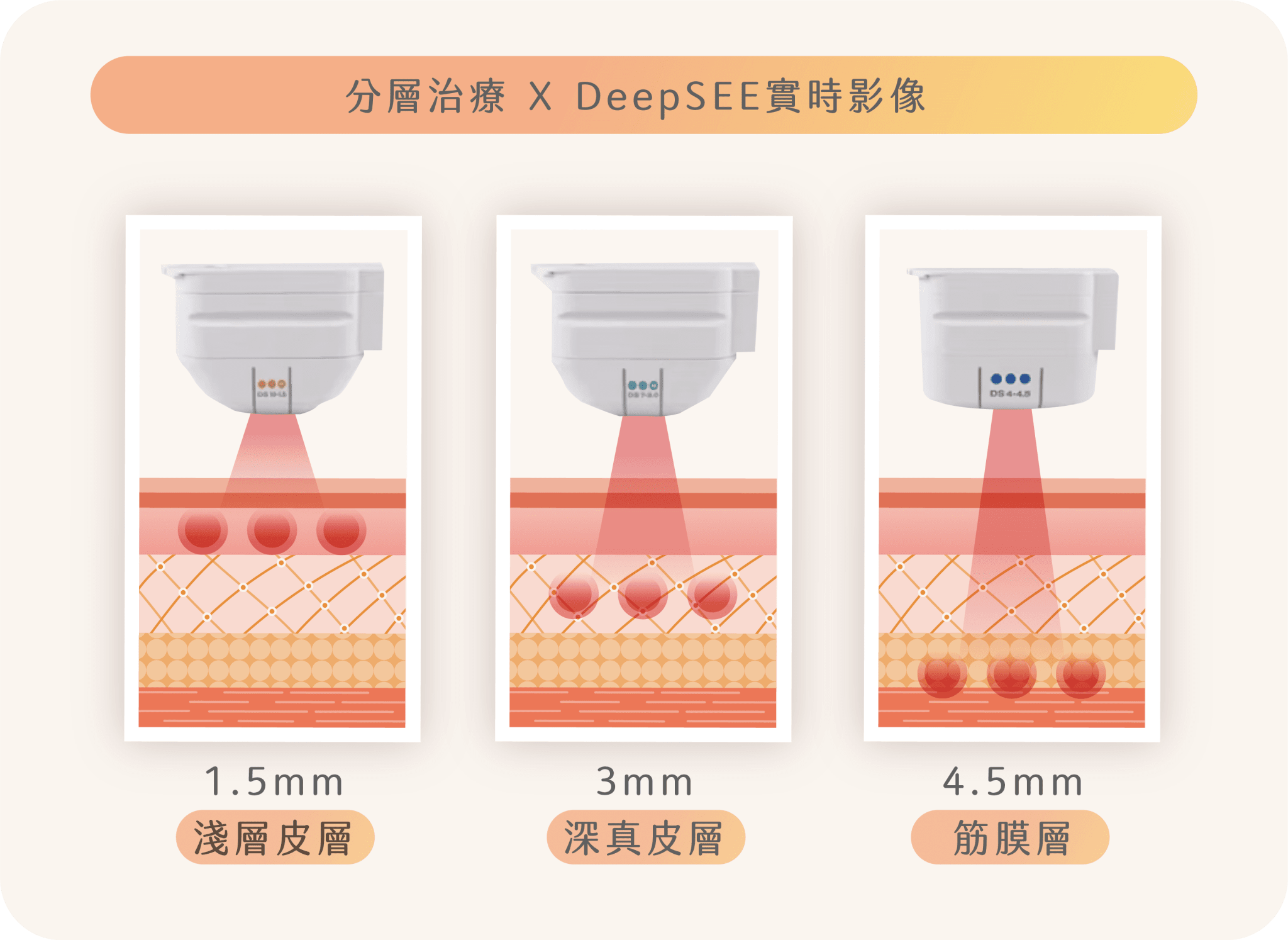 Ultherapy Prime 技術原理