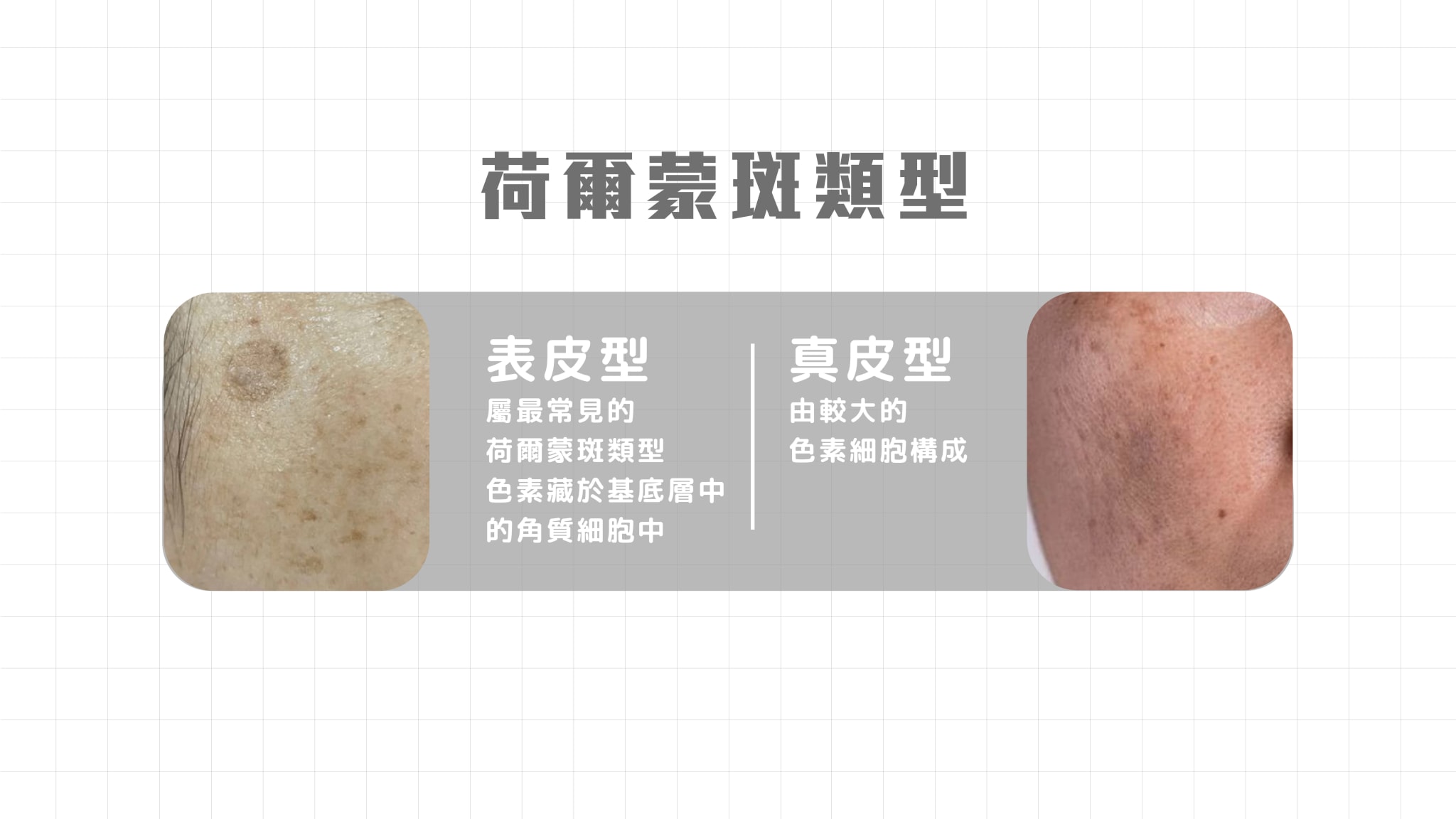 荷爾蒙斑類型
