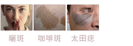 如何分辨荷爾蒙斑