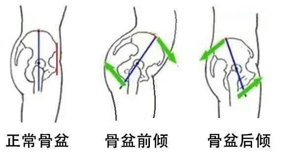 骨盤前傾