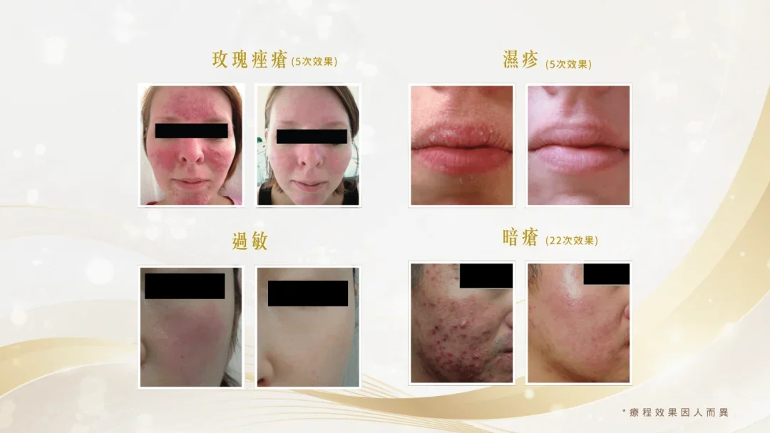 LDM水原再生細胞機前後對比效果