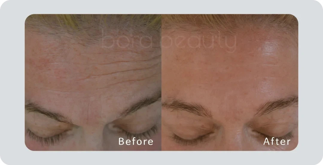 btl exilis ultra 360 btl exilis ultra 360