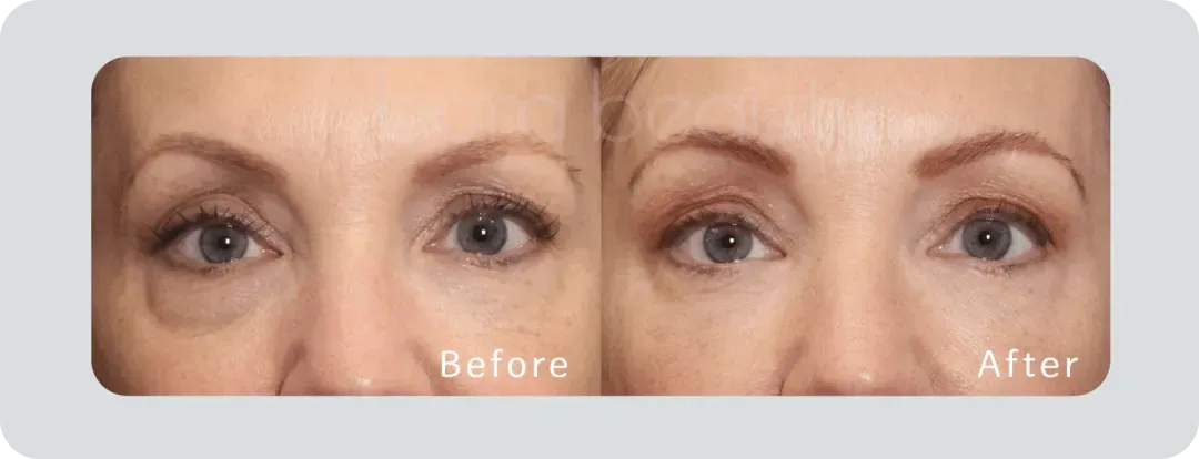 exilis ultra 360 exilis ultra 360