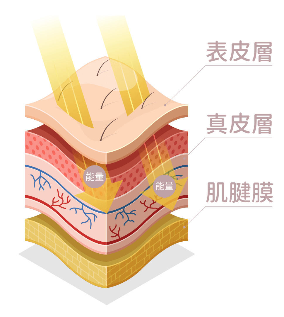 Vzet無針埋線 VS 傳統HIFU