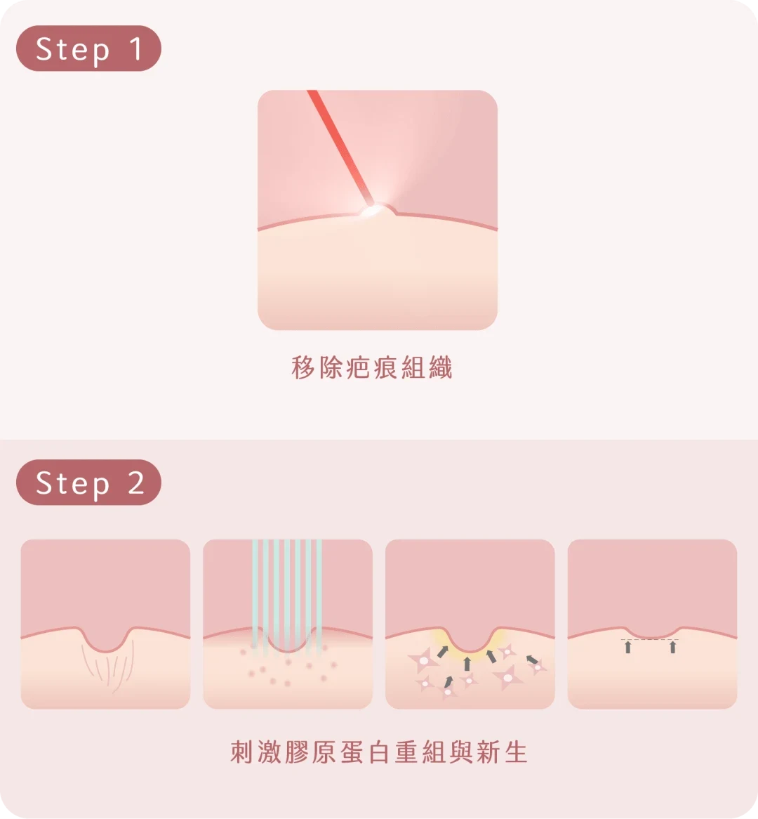 Fractional CO2 Laser原理