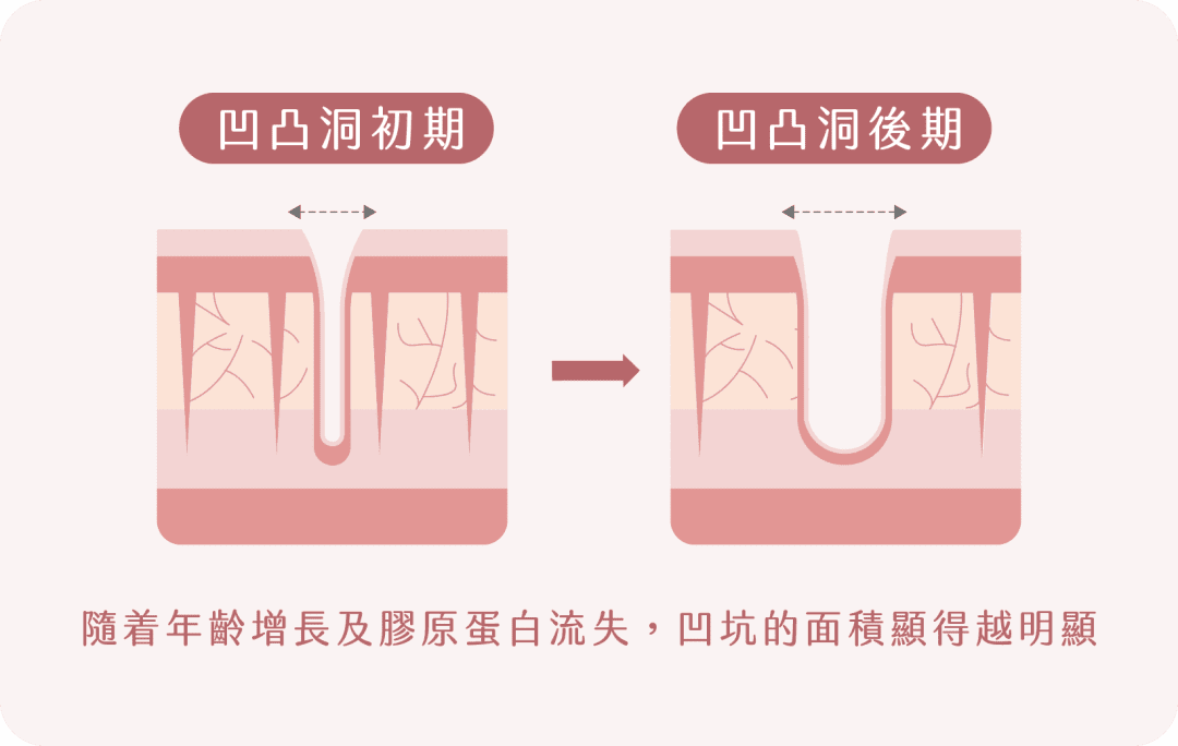 凹凸洞的形成過程