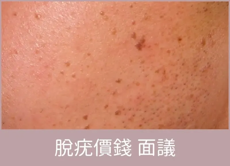 脫疣