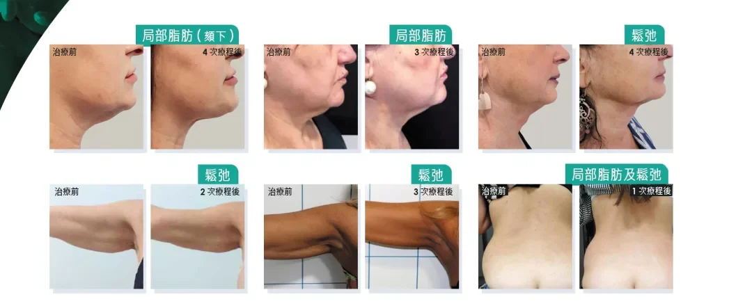 Onda Plus效果