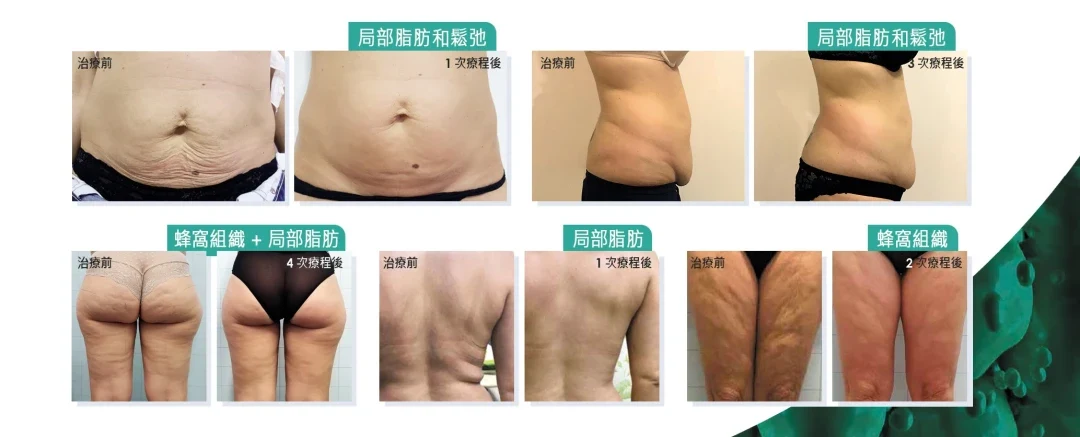 Onda Plus效果