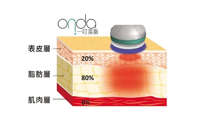 Onda第一代溶脂機