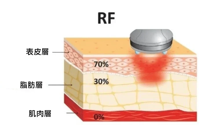 傳統RF溶脂機