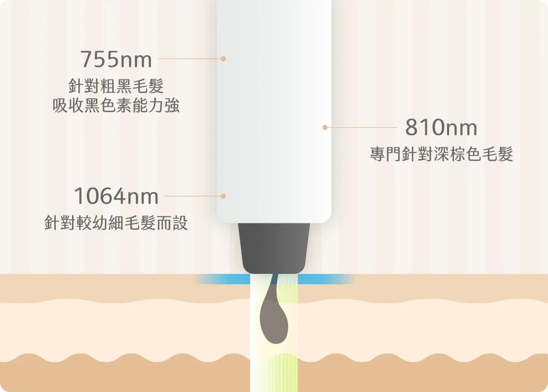 三段激光脫毛原理 三段激光脫毛原理