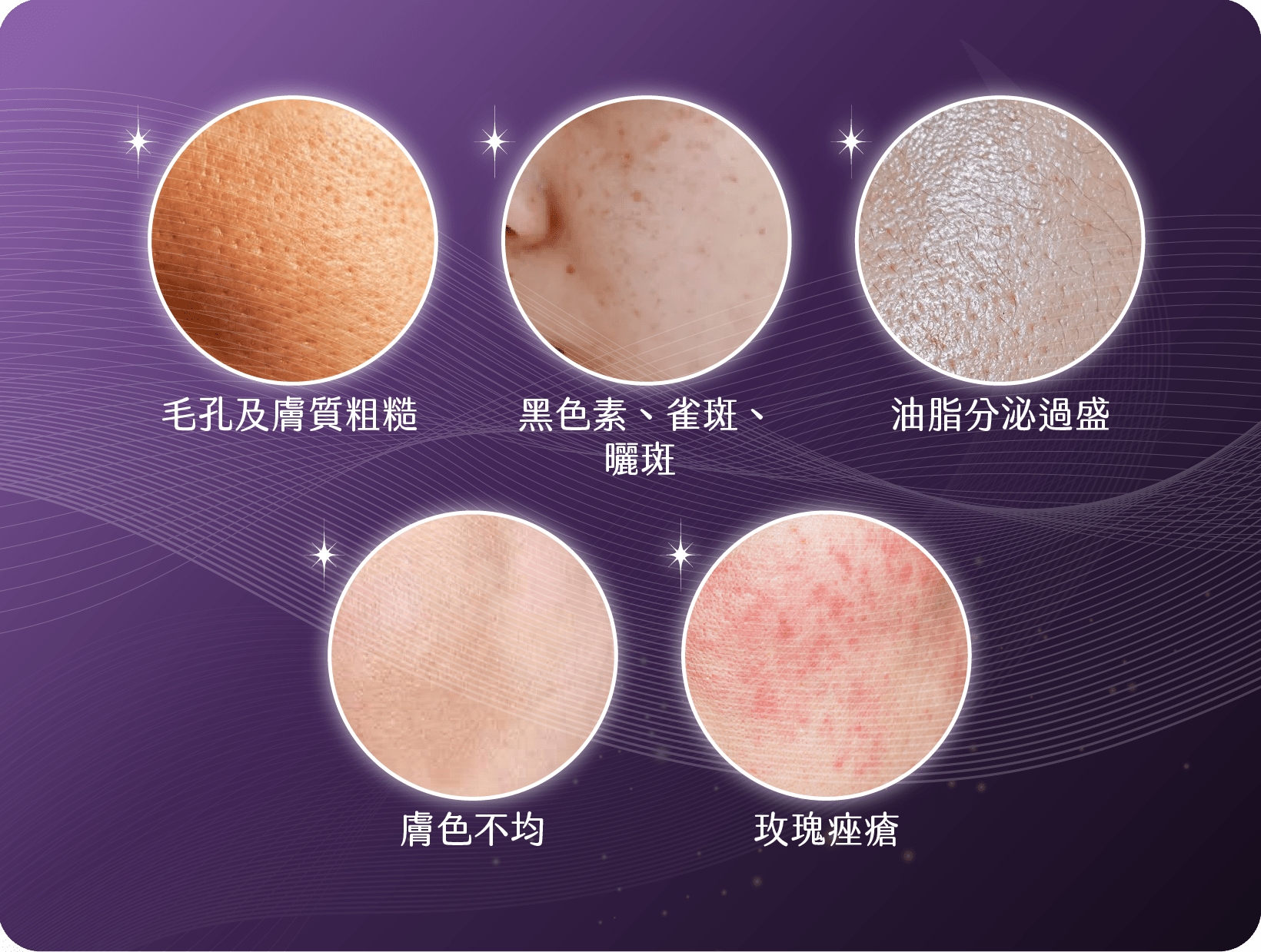 Stellar M22光子嫩膚改善問題
