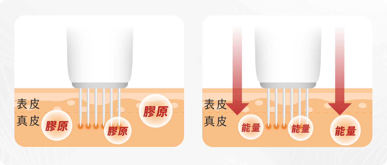 Einxel Plus膠原修復槍雙極射頻能量 Einxel Plus膠原修復槍雙極射頻能量