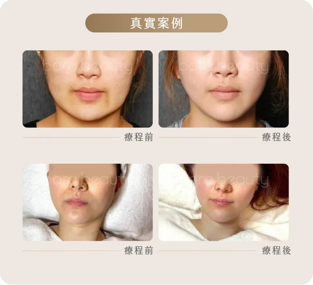 逆齡膠原提拉全效方案案例分享
