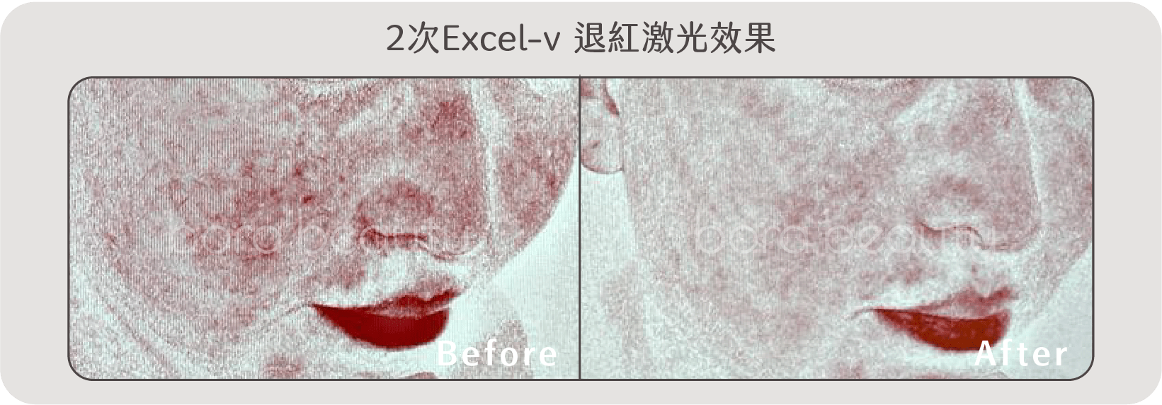 Excel-v 退紅激光效果