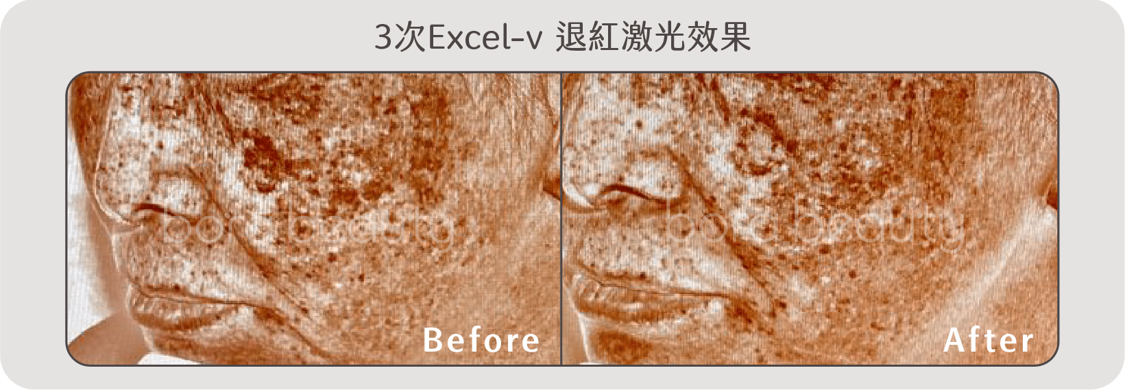 Excel-v 退紅激光效果