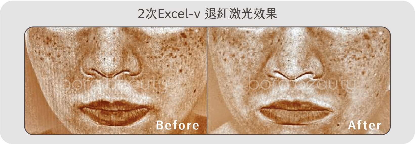 Excel-v 退紅激光效果