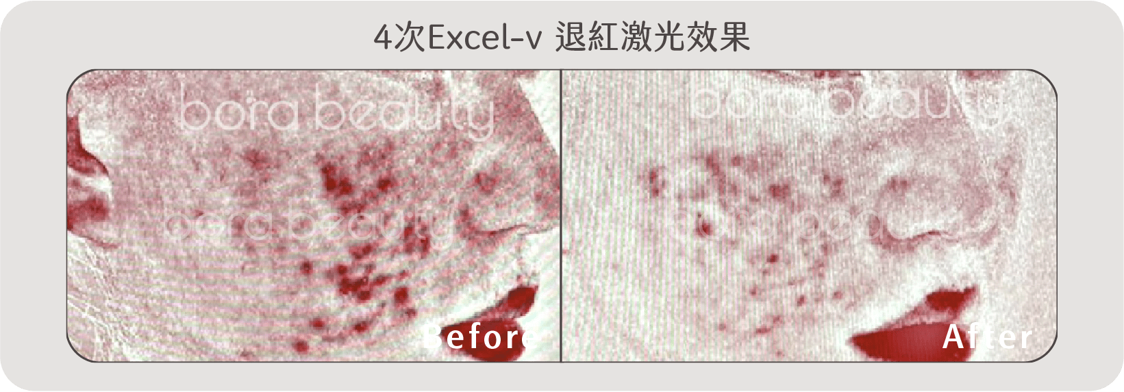 Excel-v 退紅激光效果