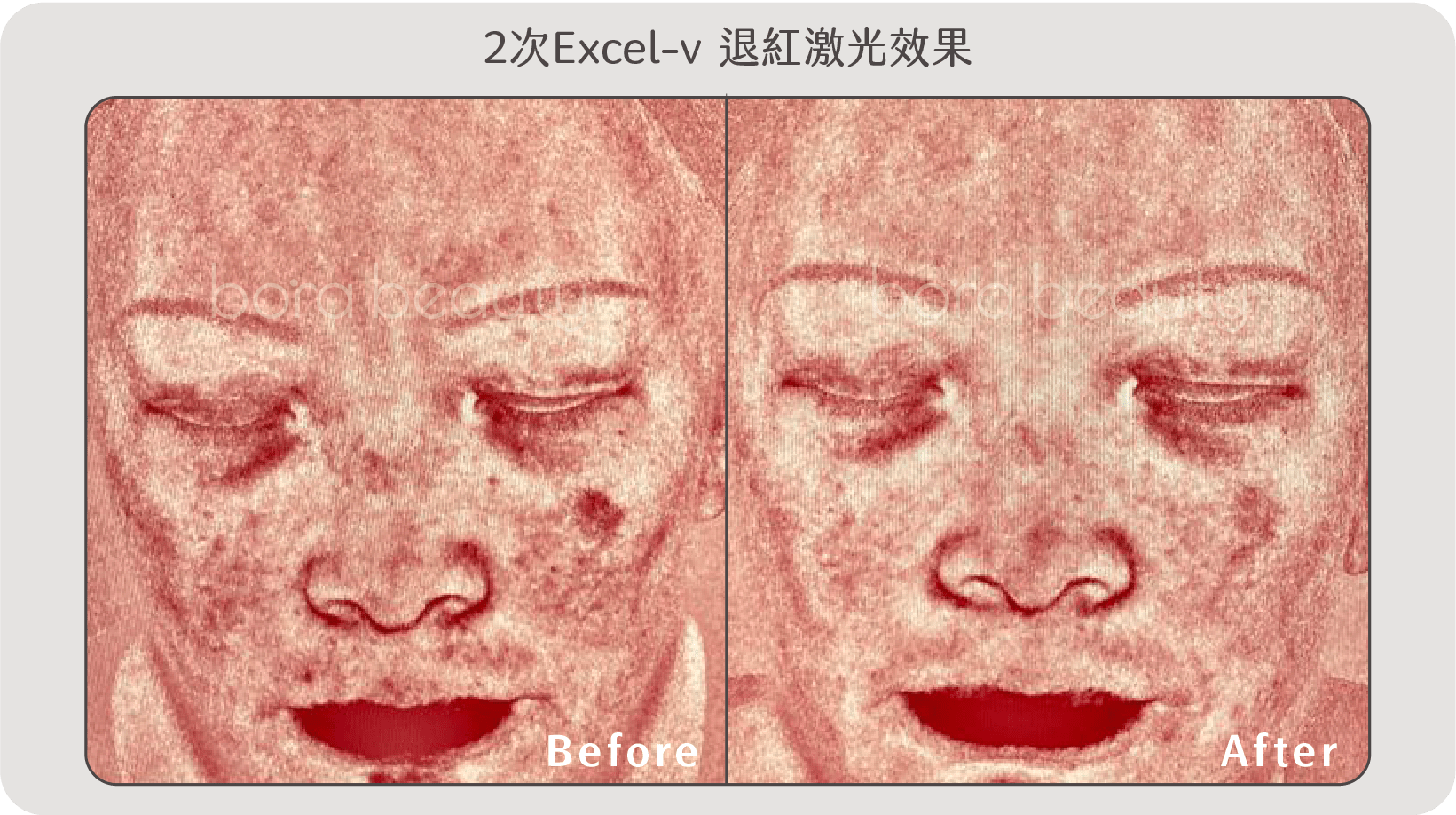 Excel-v 退紅激光效果