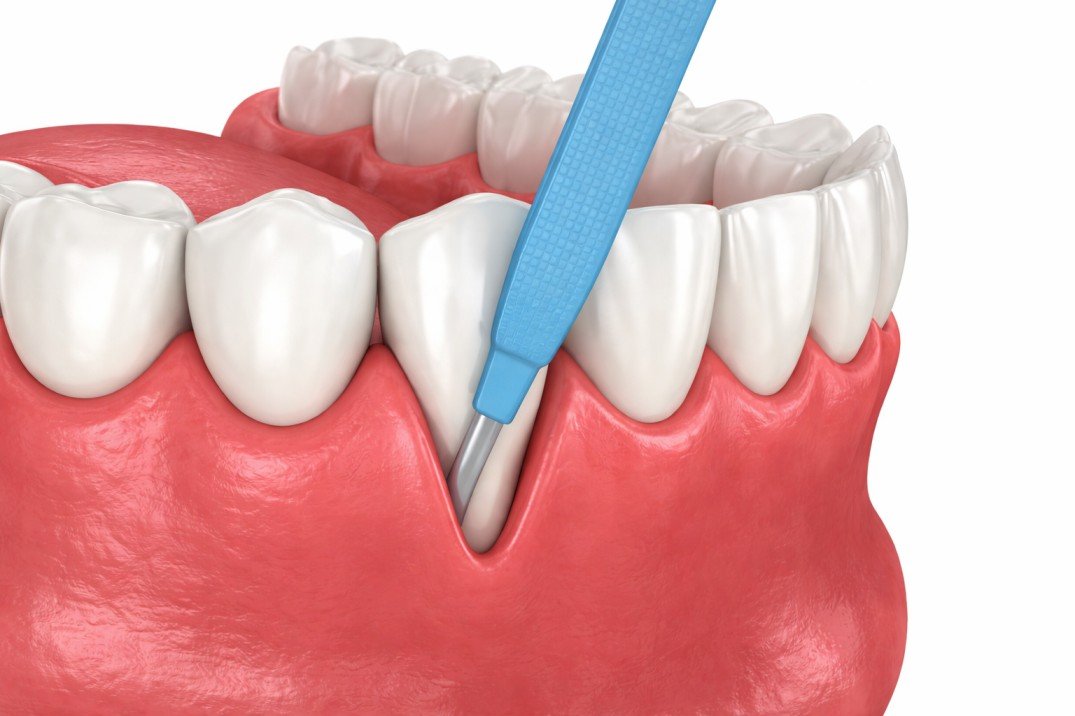 Periodontal (Gum) Surgery