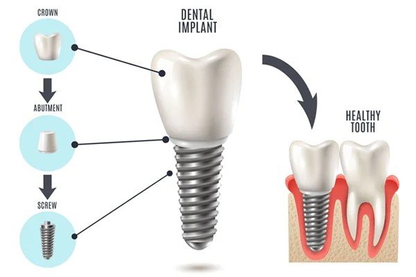 Center for Implant Dentistry