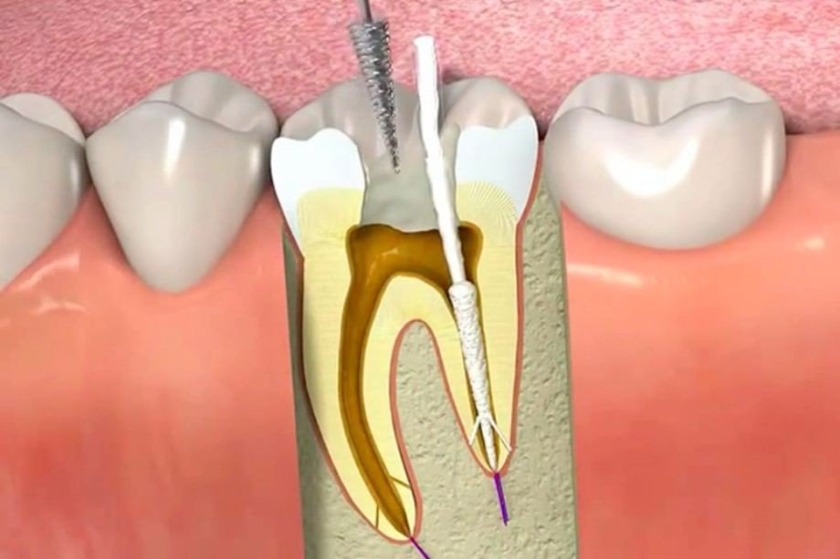 Single Sitting Root Canal Treatment