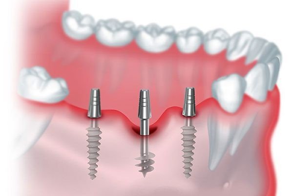 Fixed Teeth in 72 Hours