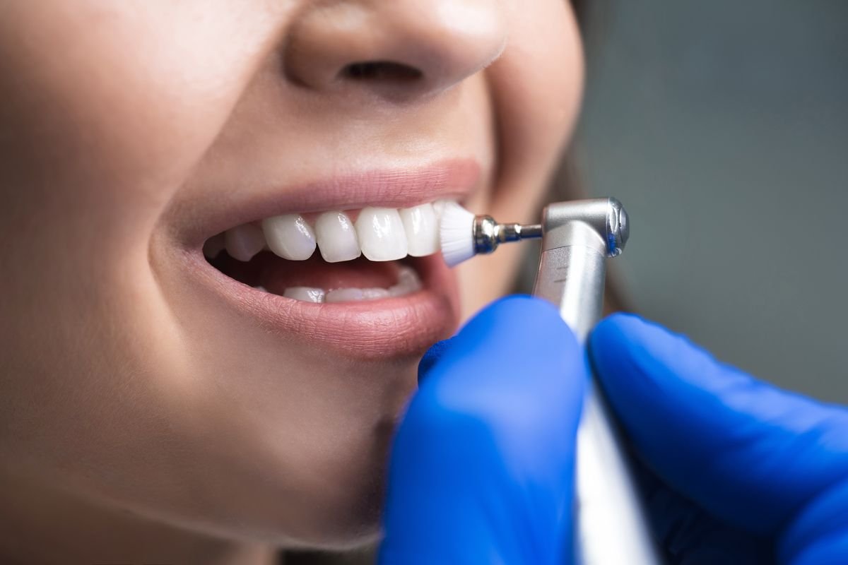 Teeth Cleaning/Scaling & Polishing