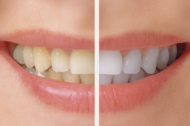 Teeth Whitening/Bleaching