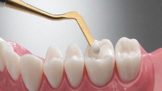 Teeth Fillings