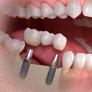 Dental Bridges
