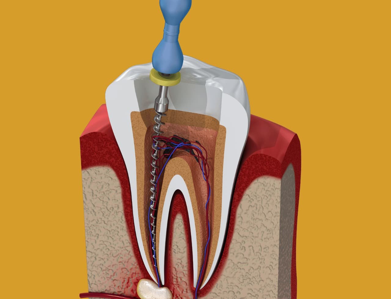 Full-mouth Rehabilitation