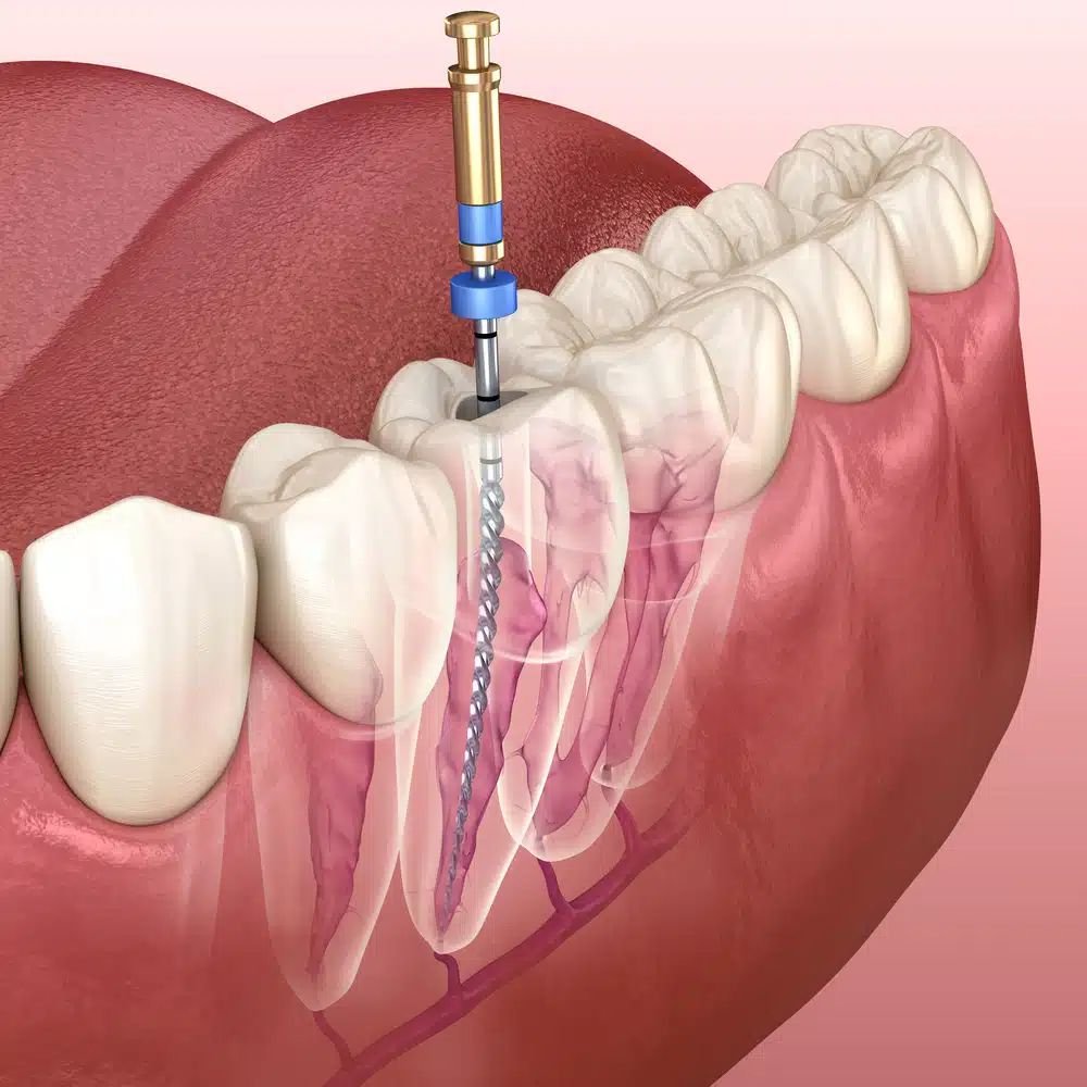 Painless Root Canal Treatment