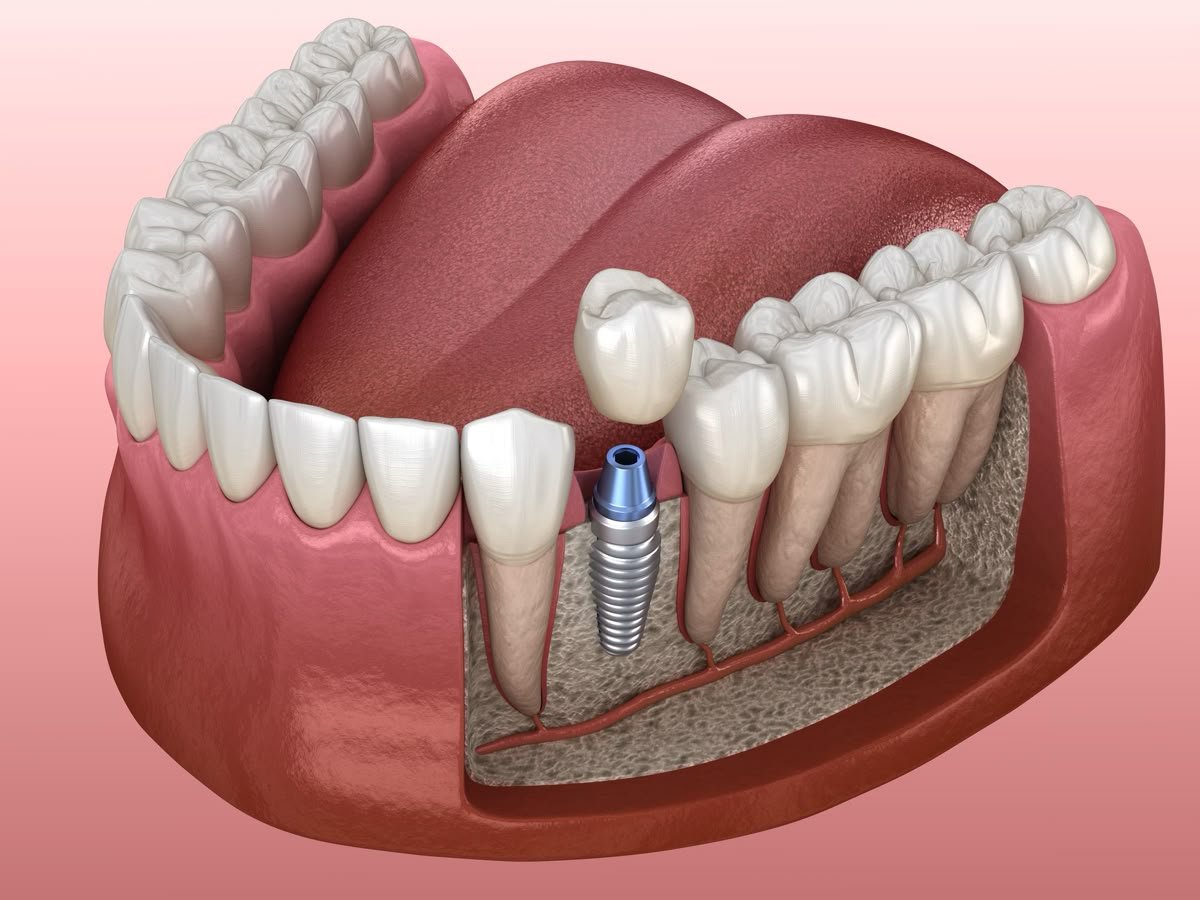 Implant