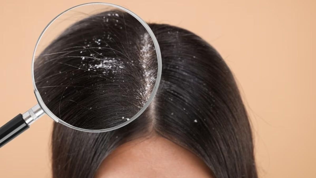 Dandruff Issues
