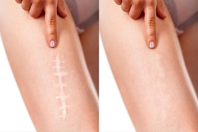 Scar Reduction