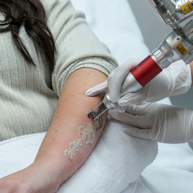 Tattoo Removal