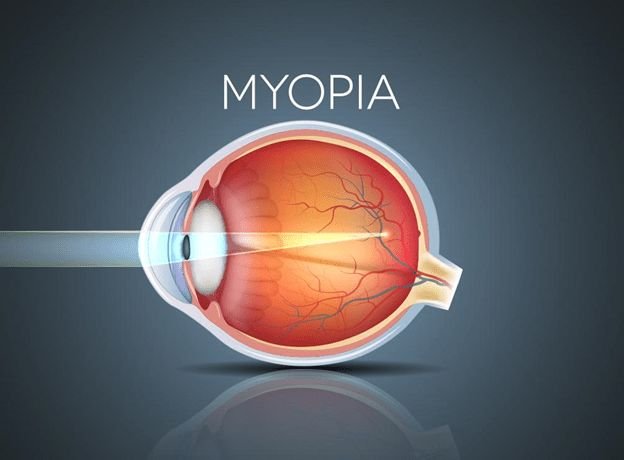 Myopia Correction