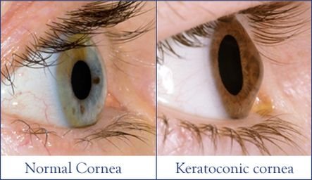 Keratoconus Lenses