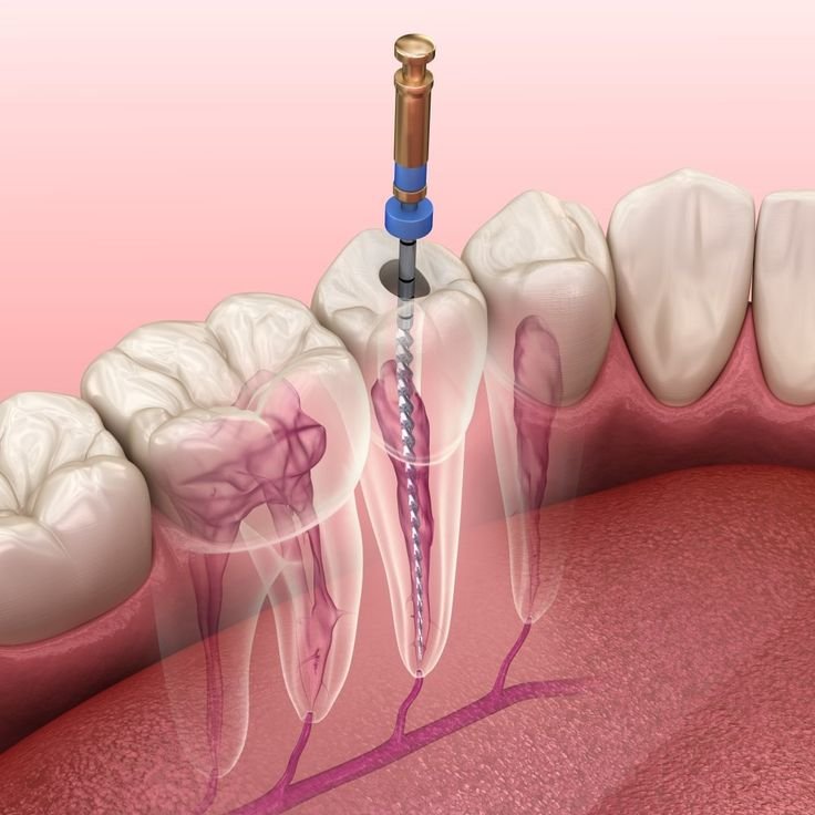 Endodontics (Root Canal)