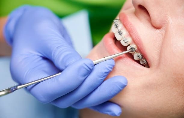 Orthodontics (Braces & Aligners)