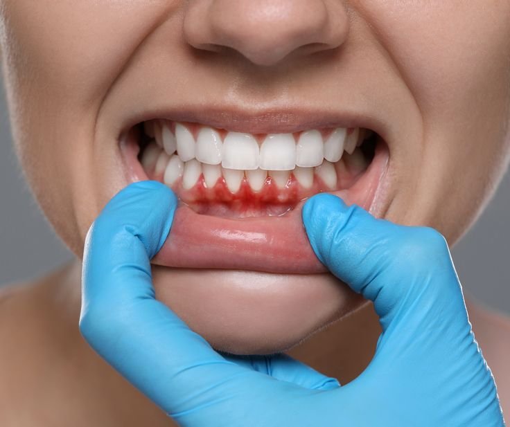 Periodontics (Gum Treatment)