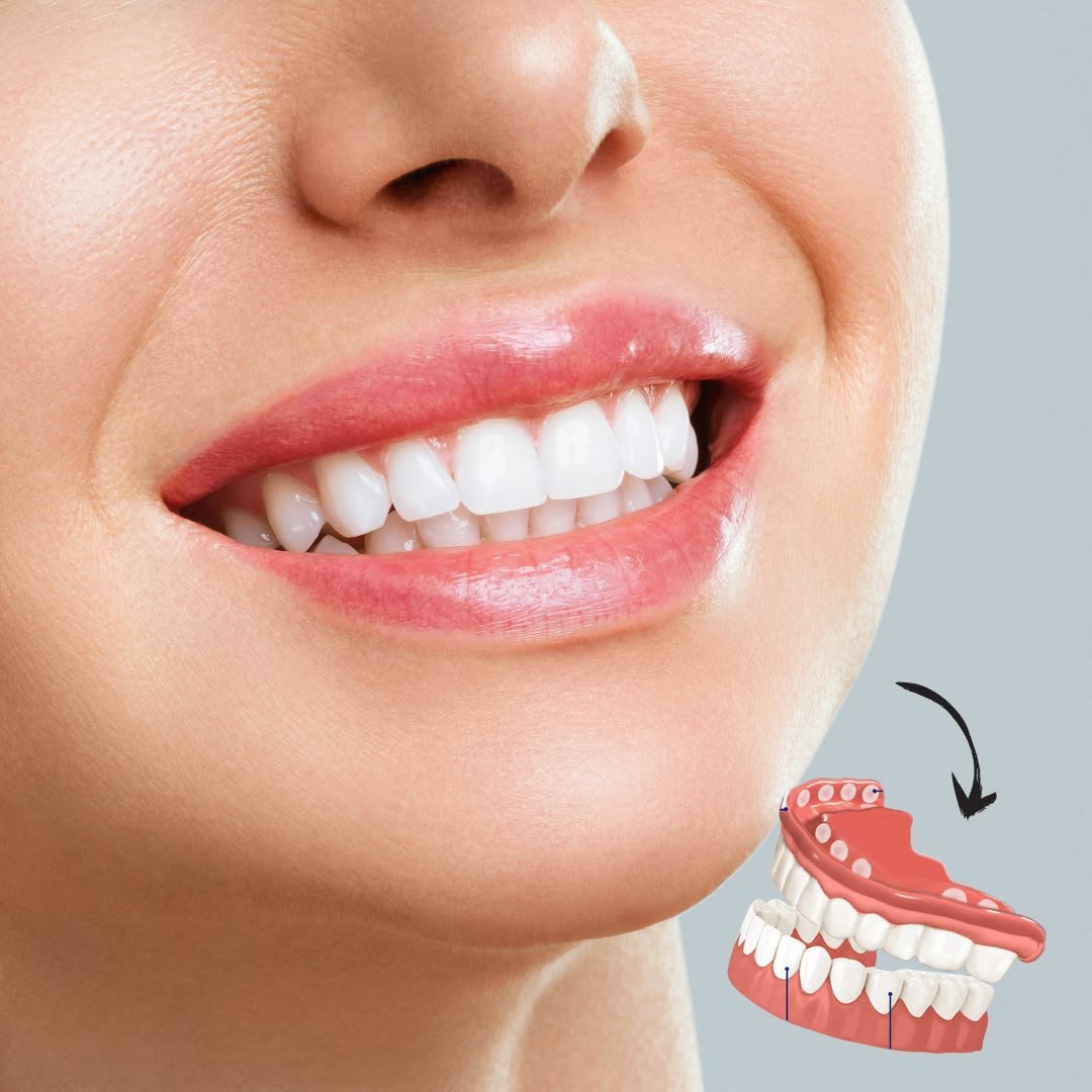 Veneers